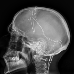 X-ray of deep brain stimulation in OCD